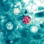 Sixth Cyclospora Outbreak Hits US As FDA Probes 72 New Diarrhea Cases
