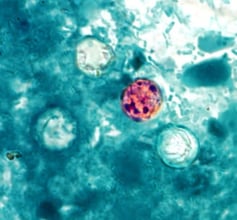 Sixth Cyclospora Outbreak Hits US As FDA Probes 72 New Diarrhea Cases